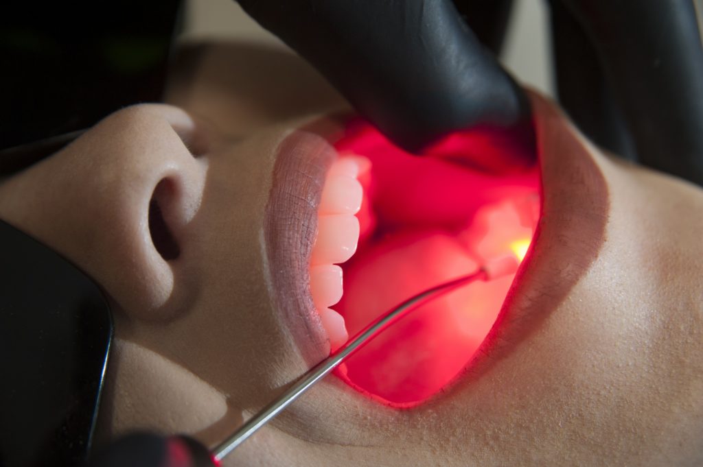 Laserterapia na odontologia: quais os benefícios e os melhores aparelhos?